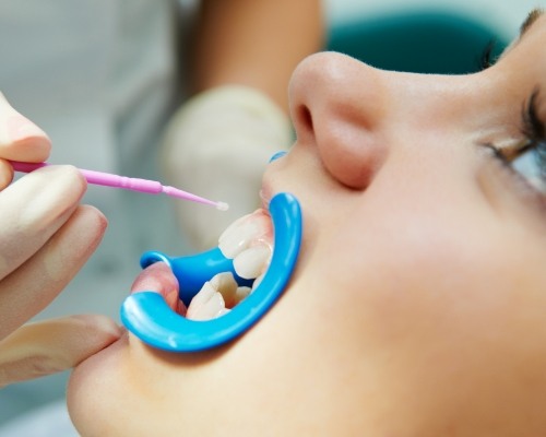 Patient receiving fluoride treatment