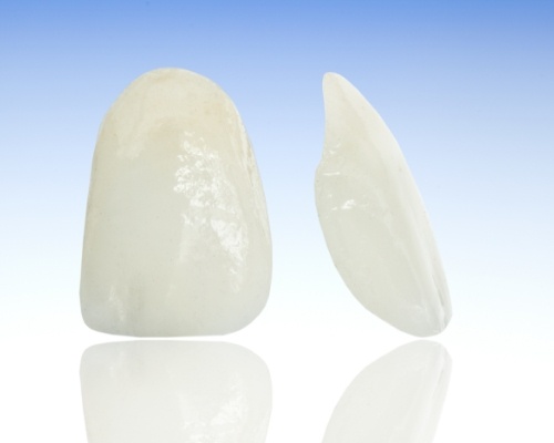 Model of metal free dental restorations prior to placement