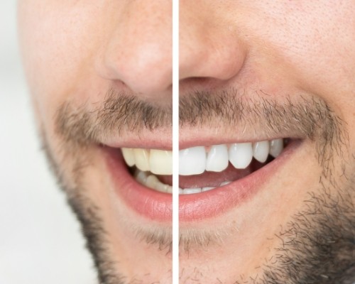 Smile before and after teeth whitening