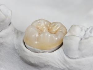 Model smile with dental crown restoration