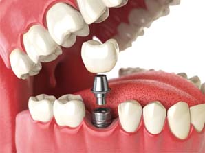 close up of dental implant