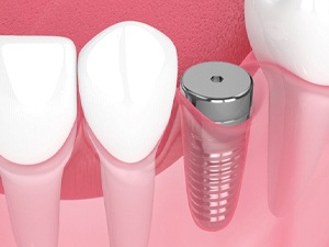 Illustration of dental implant in New City, NY with protecting cap