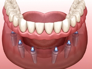 Denture being attached to dental implants in New City, NY via abutments