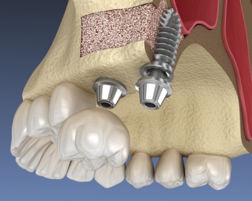 Animated smile with bone grafting