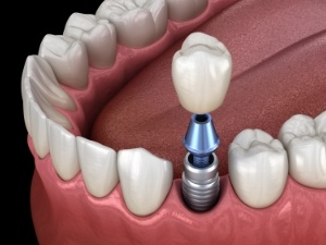 Animated smile during dental implant supported dental crown placement