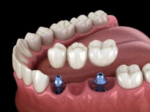 Aniamted smile during dental implant supported fixed bridge placement