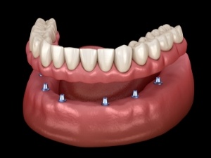 Aniamted smile during dental implant supported denture placement