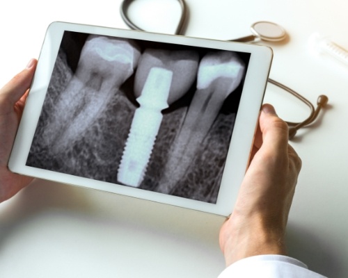 X-ray of dental implant supported replacement tooth