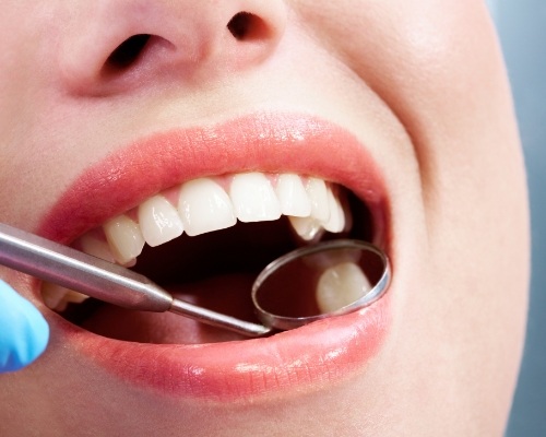 Dentist examining patient's smile after tooth colored filling treatment